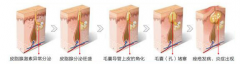 脸上长痘痘怎么处理