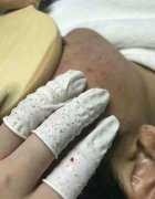 只留青春不留痘 中学生如何改善青春痘？