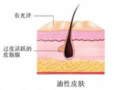 皮肤出油是不是疾病?