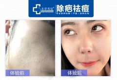 陆良县哪里祛痘痘和痘印好?