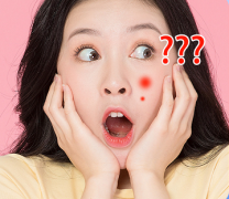 成人痘痘会不会遗传?