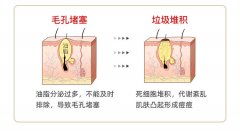 痘痘会自己消失吗?最快要多长时间好?