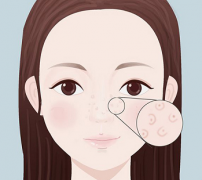 挤痘痘会导致毛孔越挤越大吗?