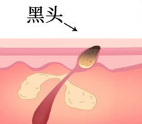 黑头不处理会有什么危害？