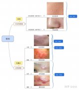 结节型痤疮是什么?要如何调理?